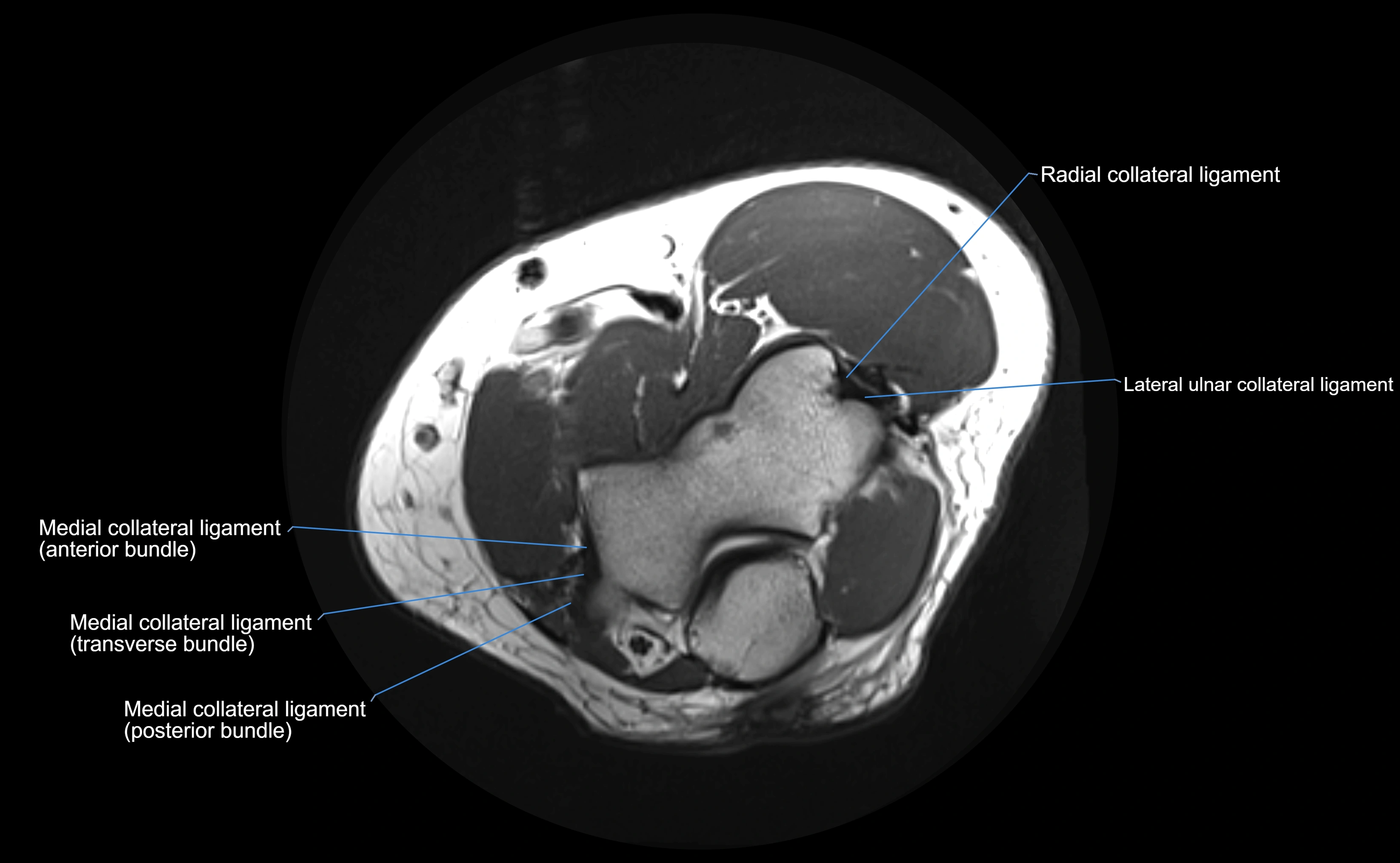 MRI elbow ligaments axial cross sectional anatomy 3T  radiology  image-img-00001-00014.webp